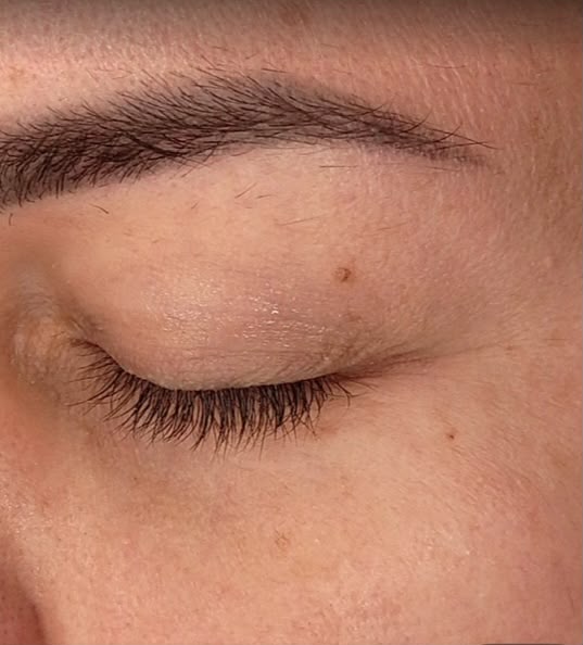 Na: gladdere huid rond het oog na Microchip Eye Patch