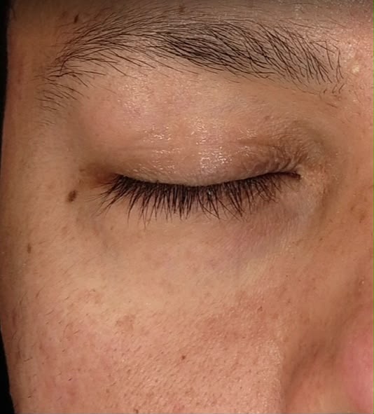 Na: egalere teint rond het oog na Microchip Eye Patch