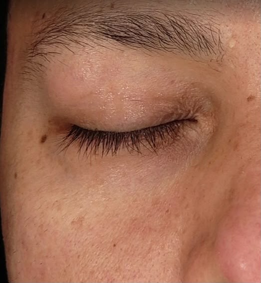 Voor: pigmentvlekken en onrustige teint rond het oog